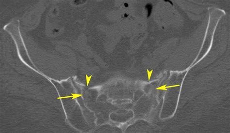 RiT radiology: Sacral Insufficiency Fracture