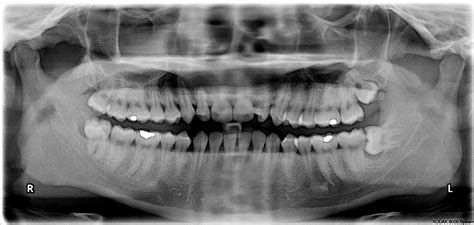 File:Impacted wisdom teeth.jpg - Wikimedia Commons