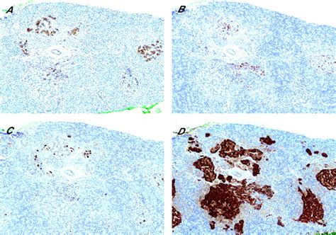 Pancreatic polypeptide cell hyperplasia of the pancreas | Journal of ...