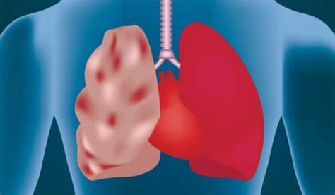 Emphysema: What Is, Causes, Diagnosis, and Symptoms