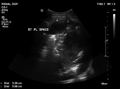 Ultrasonography showing right-sided loculated pleural effusion ...