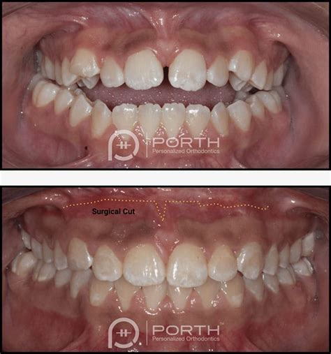 All you need to know about jaw surgery and orthodontic treatment