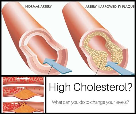 High Cholesterol - causes, symptoms and other risk factors