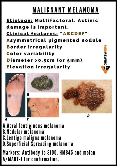 Superficial Spreading Malignant Melanoma