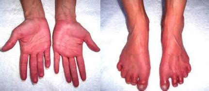 Erythromelalgia Treatment | Foot Doctor Southlake, Keller, Flower Mound ...