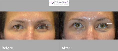 Prosthetic Eye & Socket Surgery Before and After Photos | Taban MD