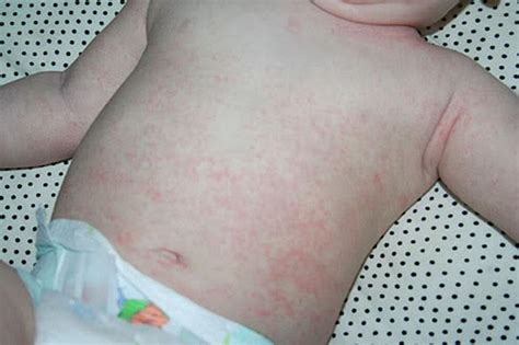 Skin Rashes In Babies