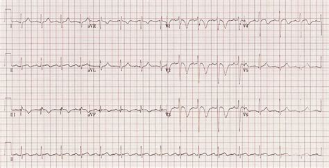 Right Ventricular Strain • LITFL • ECG Library Diagnosis