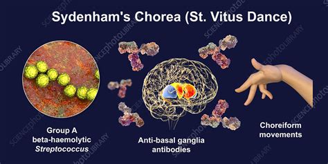 Sydenham's chorea, illustration - Stock Image - F033/7336 - Science ...