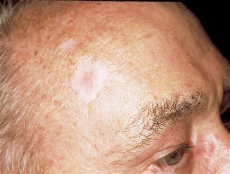 What is Non-melanoma skin cancer? - Haleroadmedical