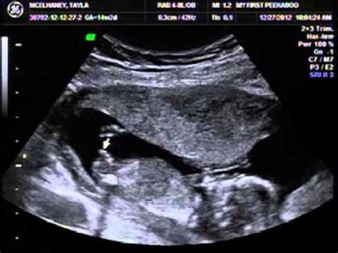 baby ultrasound pictures 12 weeks - Cyndy Kimmel