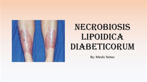 Necrobiosis Lipoidica Diabeticorum