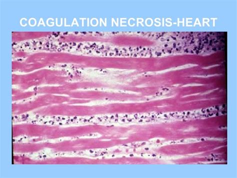 General pathology lecture 3 cell death or necrosis