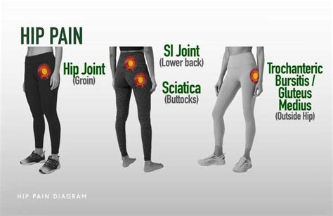 Various Causes of Hip Pain - A Blog Post From Emed