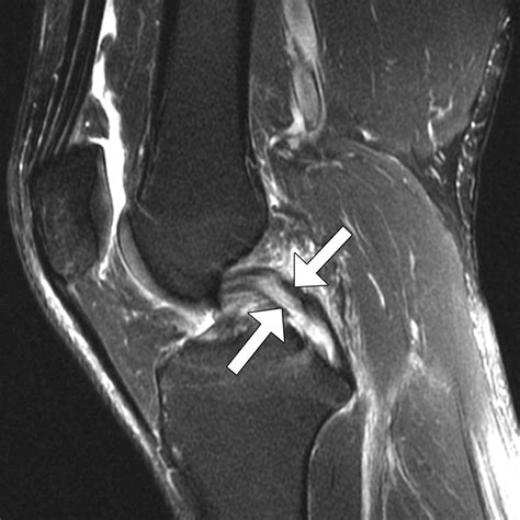 Tram-Track Appearance of the Posterior Cruciate Ligament (PCL ...