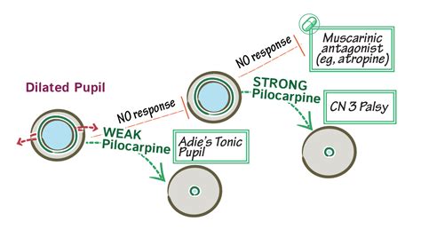 Neuroanatomy Glossary: Adie’s tonic pupil | Draw It to Know It