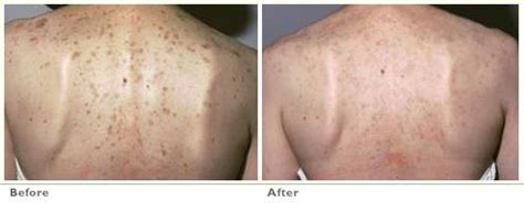 Remove Brown & Age Spots By Q Switched ND YAG Laser - BSI