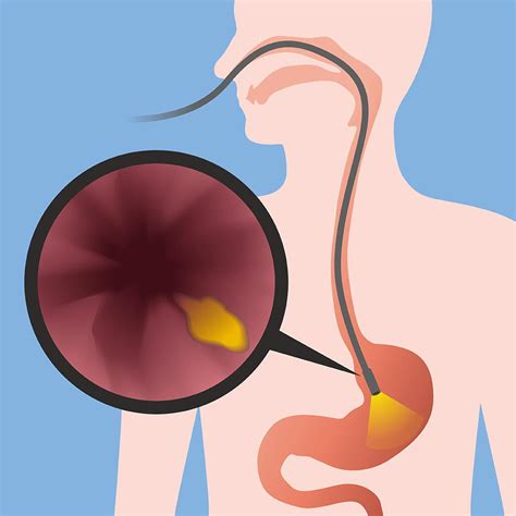 Gastroscopy and Endoscopy - Queensland Gastroenterology