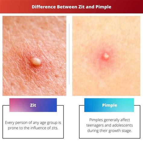 Zit vs Pimple: erinevus ja võrdlus