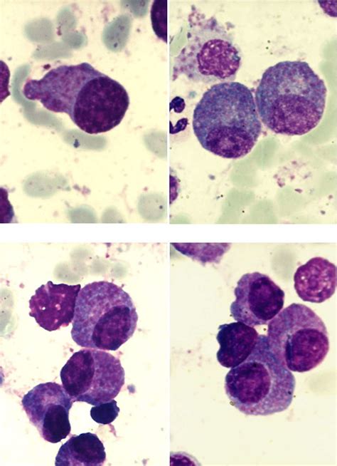 a, 4b-Clusters of plasma cells with azurophilic granules (MO-MGG, 100x... | Download Scientific ...