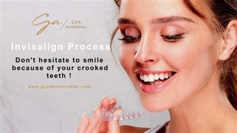 Invisalign Process