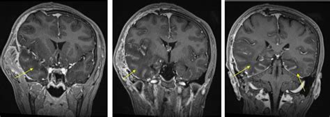Herpes simplex encephalitis – Radiology Cases