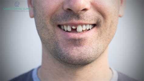 Missing a Front Tooth? Here are 3 Ways You Can Feel Confident