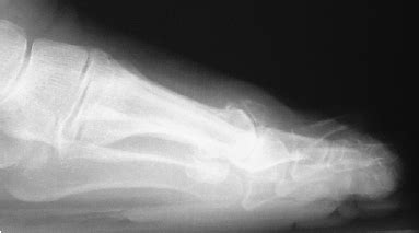 X-ray depicting hallux rigidus with characteristic loss of joint space. | Download Scientific ...