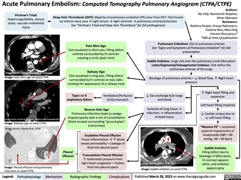 Acute Pulmonary Embolism: Computed Tomography Pulmonary Angiogram (CTPA ...