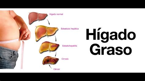 Hígado graso: Síntomas, Diagnóstico, Tratamiento y Prevención - Esteatosis hepática - YouTube