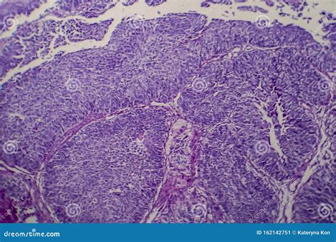 Transitional Cell Carcinoma