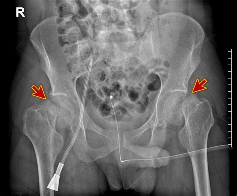 Human Female Pelvis X Ray