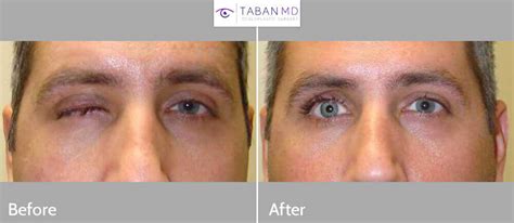 Prosthetic Eye & Socket Surgery Before and After Photos | Taban MD