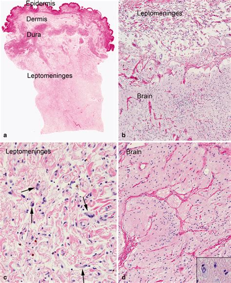 Encephaloceles | SpringerLink