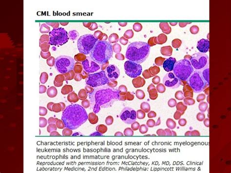 Myeloproliferative disorders