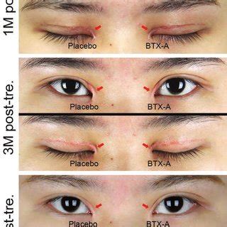 Inverted 'V-Y' advancement medial epicanthoplasty | Request PDF