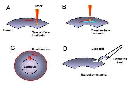 SMILE Eye Surgery- Procedure, Benefits, Cost, Risks & More