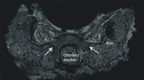 The transverse ligament in axial view acquired using imaging at 4.6T ...