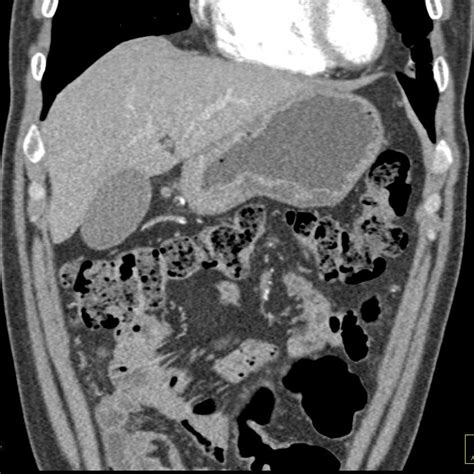 Omental Carcinomatosis - Gastrointestinal Case Studies - CTisus CT Scanning