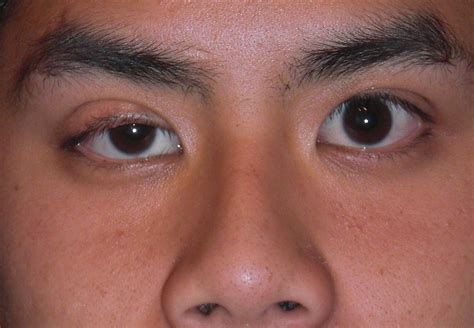 What Is Ptosis and Miosis? » Scary Symptoms