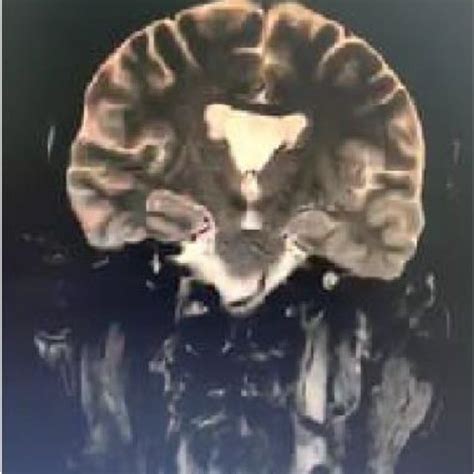 Head MRA scan without contrast. The axial view was suggestive of ...