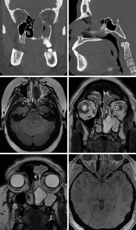 Encephalocele | The Neurosurgical Atlas