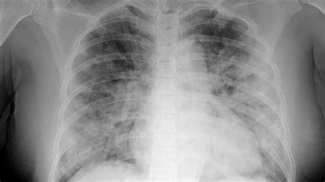 Chest CTs Reveal Abnormalities 2 Years After Severe COVID | MedPage Today