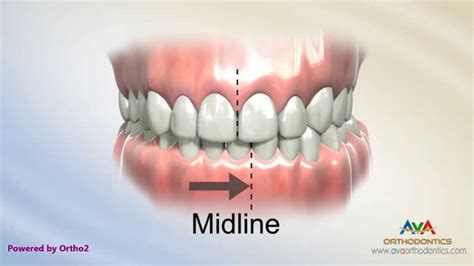 How To Fix A Crossbite In Adults / Non-Surgical Orthodontic Treatment of Class III Adult with ...