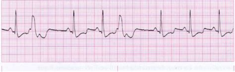 Ventricular Arrhythmias Flashcards | Quizlet