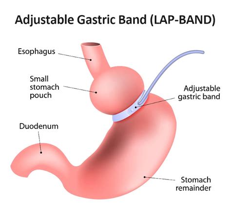 Lap Band in Mexico (Gastric Banding): Starting at $5,495