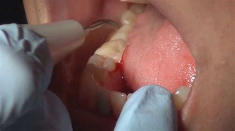 How to do Full Mouth Debridement - YouTube