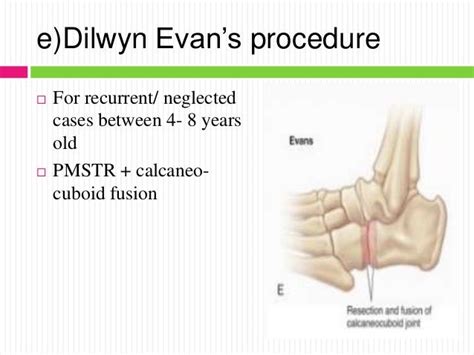 Mellss yr5 ortho treatment of congenital talipes equino varus (ctev)