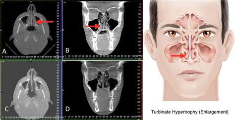 turbinate hypertrophy