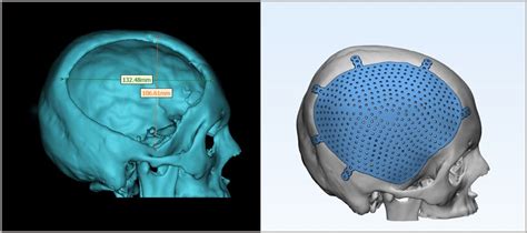 Cranial Implants - 3DIncredible